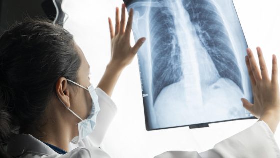 Early detection may help Kentucky tamp down its lung cancer crisis – MASHAHER