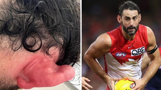 Brodie Grundy stung by bluebottle jellyfish before Swans Opening Round win vs Demons, photo, reaction, news – MASHAHER