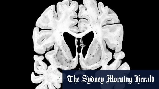 Alzheimer’s, Lewy Body dementia markers found in former rugby league, union players – MASHAHER