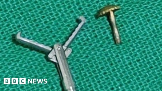 Surgery for Indian woman who inhaled nose pin – MASHAHER