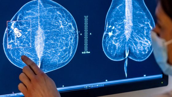 In Reversal, Expert Panel Recommends Breast Cancer Screening at 40 – MASHAHER