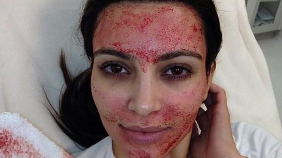 Women Diagnosed With HIV After “Vampire Facial” Procedures Popularized by Kim Kardashian – MASHAHER