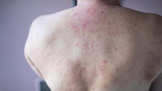 Years of hives and fevers traced to a startling cause – MASHAHER