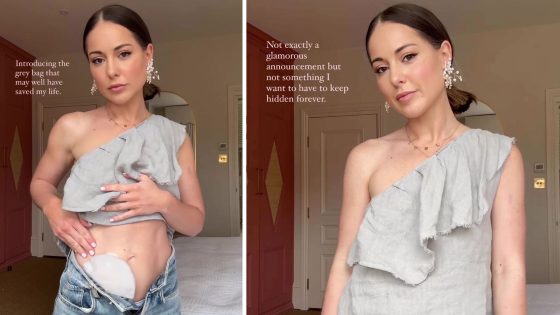 Louise Thompson reveals stoma bag after months of health problems: ‘It may well have saved my life’ | Ents & Arts News – MASHAHER