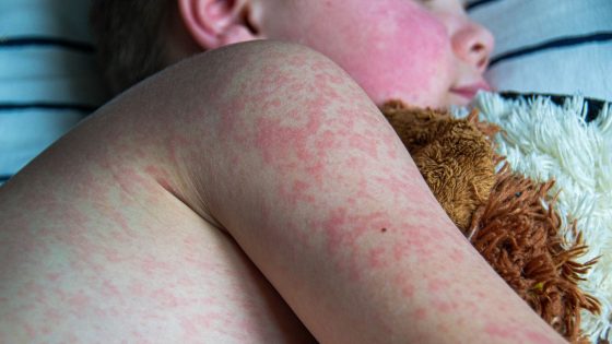 Measles cases worldwide almost double in a year – as England faces measles ’emergency’ | World News – MASHAHER