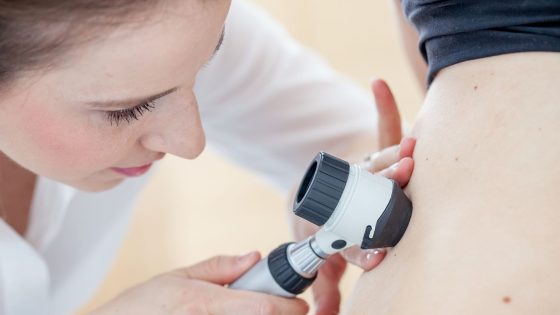 Melanoma skin cancer cases at all-time high in UK | UK News – MASHAHER