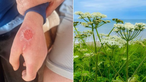 Boy, 8, ‘scarred for life’ after toxic giant hogweed plant causes blisters and burns | UK News – MASHAHER