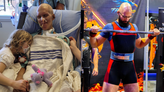 Canadian powerlifter spent 5 weeks on life support after developing rare life-threatening illness – MASHAHER