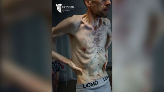 Photos of released Ukrainian prisoners of war show emaciated bodies in ‘horrifying’ condition – MASHAHER