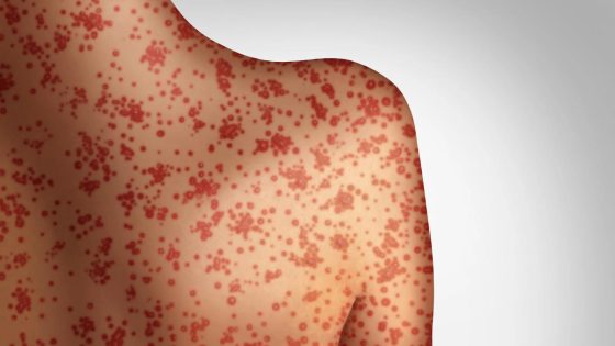 Traveler infected with confirmed case of measles at Seattle International Airport as cases in US increase – MASHAHER