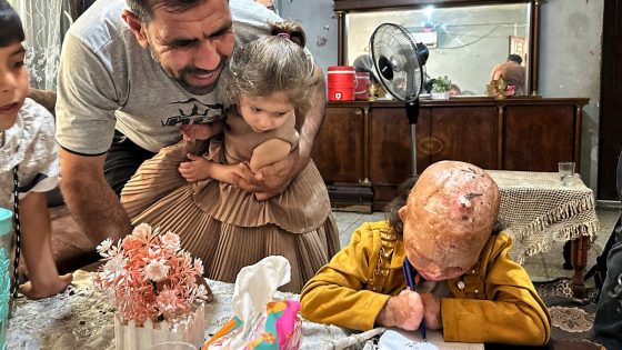 ‘Miracle baby’ burned in tent fire beating the odds – but mum says she’s shunned by society | World News – MASHAHER