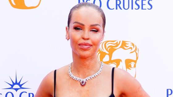 Katie Piper forced to pull out of ITV show for ‘unexpected medical procedure’ | UK News – MASHAHER