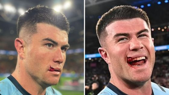 Bradman Best’s split lip is as disgusting as it gets as NSW Blues defeat Qld Maroons – MASHAHER