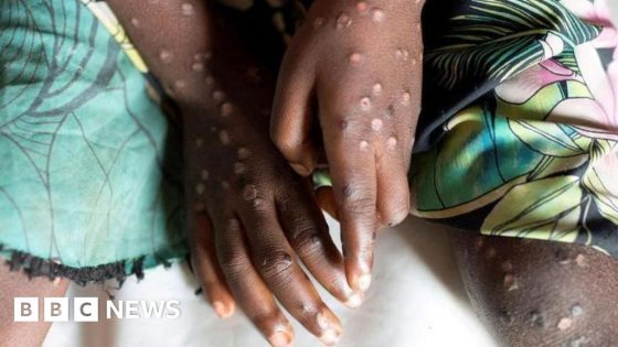 Mpox not new Covid and can be stopped, expert says – MASHAHER