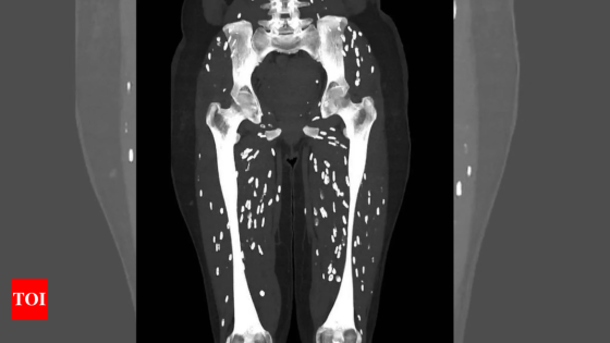 Google: ‘One of the craziest CT scans’: Doctor shares pictures of patient’s legs filled with parasites – MASHAHER