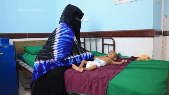 Famine is looming in four Yemeni districts as malnutrition surges among children, a new report says – MASHAHER