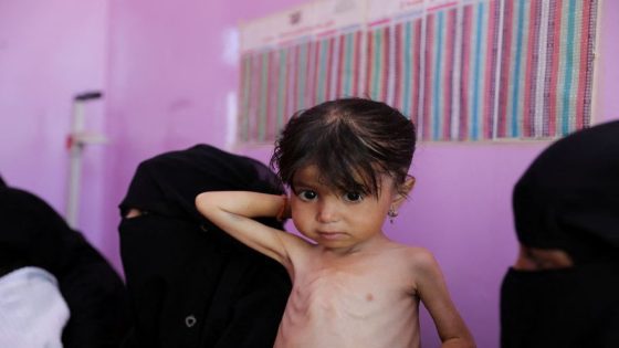 Malnutrition worsening in Yemen’s government-controlled areas, UN says – MASHAHER