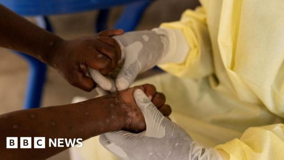 First case of more contagious mpox found outside Africa – MASHAHER