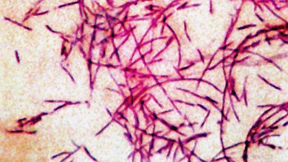 5 diagnosed with Legionnaires’ disease in New Hampshire, health officials say – MASHAHER