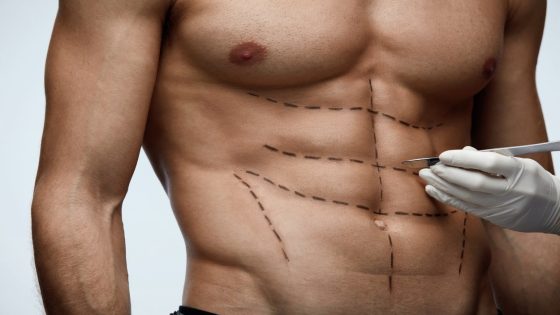 ‘Six-pack surgery’ gaining popularity among men, say plastic surgeons – MASHAHER