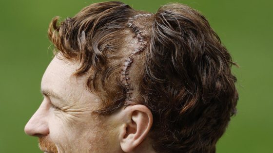 Gary Rohan returns to Geelong training after skull surgery, photos of 50 staples in his head, latest news – MASHAHER