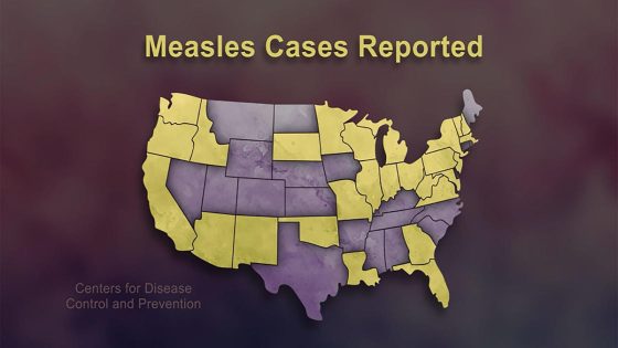 As measles cases increase, experts warn against vaccine skepticism – MASHAHER