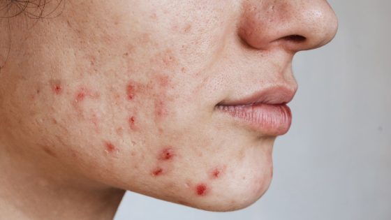 Germany’s teenagers and young people have worst acne, with UK in the top 10, study finds | UK News – MASHAHER