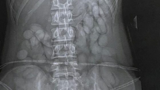 X-ray reveals ‘cocaine bullets’ found in stomach of woman stopped at airport | World News – MASHAHER