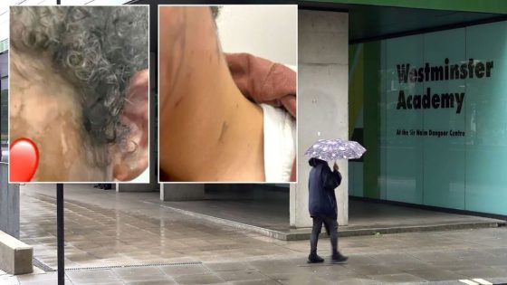 Injuries of schoolgirl, 14, attacked with acid in broad daylight revealed in shocking pictures as dad sets up fundraiser – MASHAHER