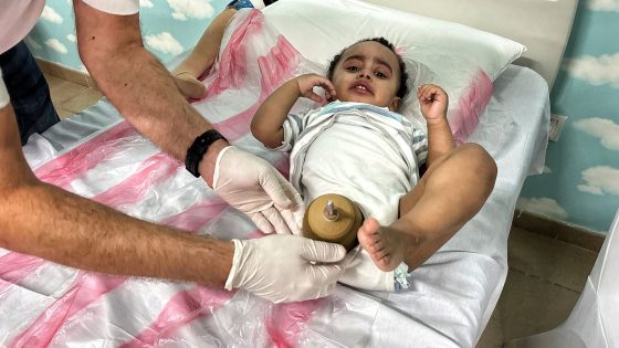 ‘The doctor told me count to three – and he cut my leg’: The generation of Palestinian children with devastating amputations after a year of war | World News – MASHAHER